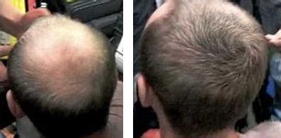 LLLT Hair Growth Results - Before and After Images