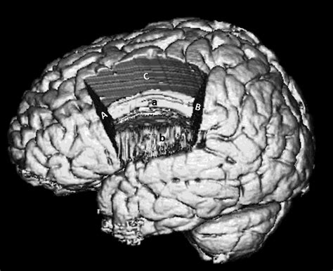 Technical descriptions of four hemispherectomy approaches: From the ...