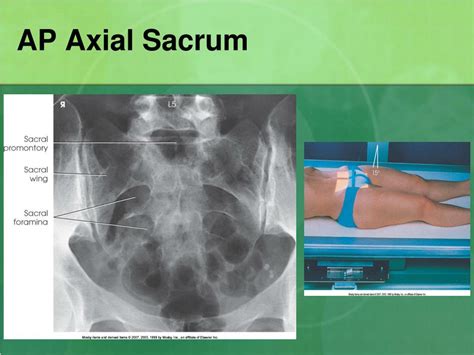 Ligaments Of The Sacrum