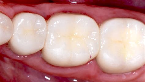 What you should know about Composite Fillings | Golden Smiles Dental