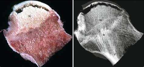 The Pathology of Osteonecrosis of the Femoral Head | Radiology Key