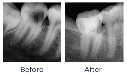 The Role of Bioceramic Materials in Contemporary Endodontics