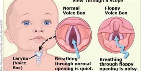 Living with A Laryngomalacia baby | Pediatric nursing, Kids health, Pediatrics