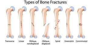 Fractures are an important complication of day to day accidents