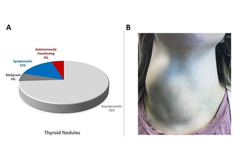 Shrinking Thyroid Nodules with Radiofrequency Ablation