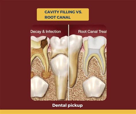 Cavity Filling vs. Root Canal - Two Main Difference - Dental Pickup
