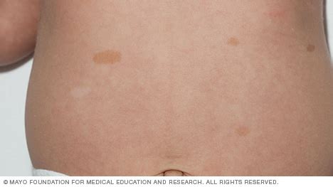 Slide show: Birthmarks - Mayo Clinic