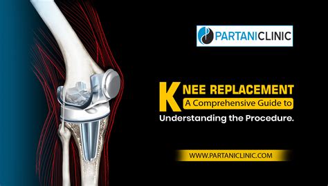 Knee Replacement Surgery Guide - Comprehensive Guide | Partani Clinic