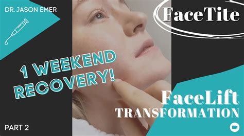 FaceTite: Facelift Transformation with Only a Weekend's Recovery ...