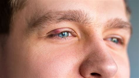 Eye Infections & Pinkeye Treatment | College Station TX | Urban Optics