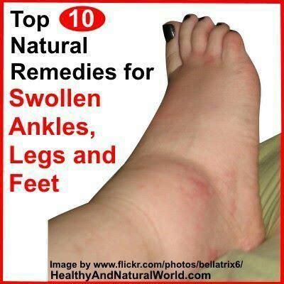 In Case You Missed: The Top 10 Natural Remedies for Swollen Ankles, Legs and Feet