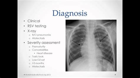 Bronchiolitis - USMLE Step 2 Review - YouTube