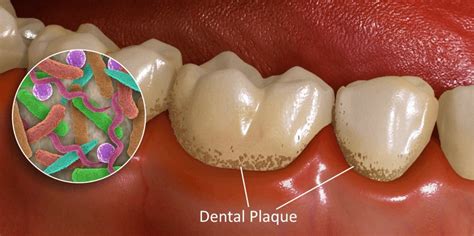 dental-plaque-bacteria | Kuipers Ortho