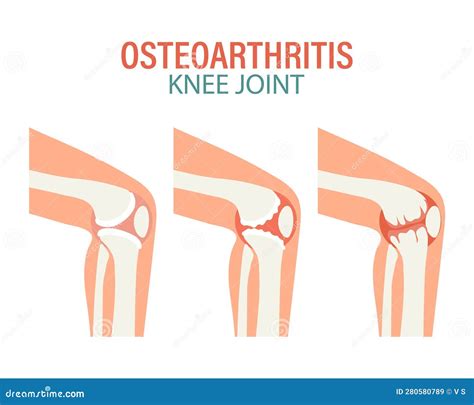 Rheumatoid Arthritis. Osteoarthritis Of The Knee Joints. Medical Concept. Infographic Poster ...
