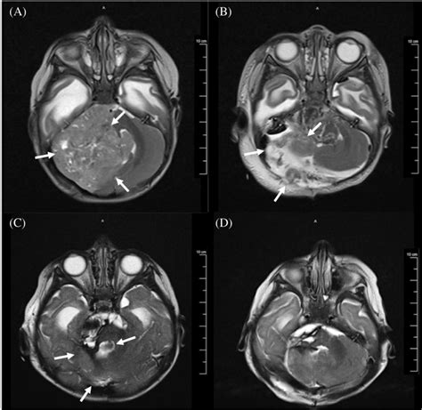 Axial T2 MRI, here depicting the level of the posterior fossa: (A ...