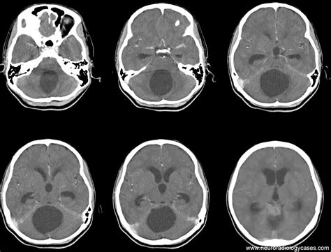 Dr Balaji Anvekar FRCR: Posterior fossa cystic mass MRI