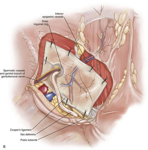 Laparoscopic Repair of Complex Scrotal Hernia | Abdominal Key