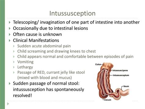 Intussusception,what you need to know.