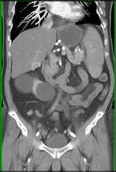 Islet Cell Tumor- See Next Case - Musculoskeletal Case Studies - CTisus ...