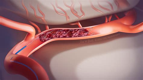 Brain Aneurysms & Cerebrovascular Disease- Symptoms & Treatment ...