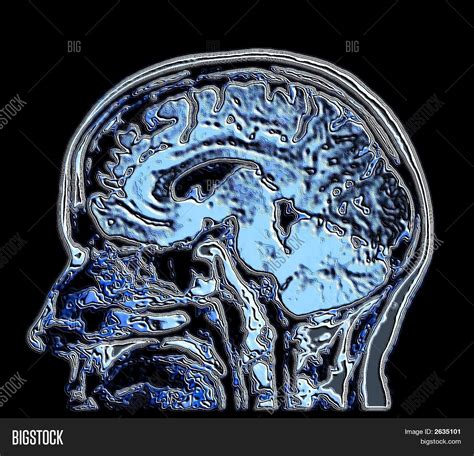 2D Mri Brain Image 6mm Image & Photo (Free Trial) | Bigstock