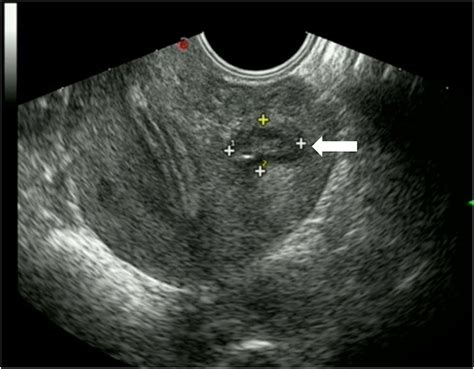 Adenomyosis Ultrasound