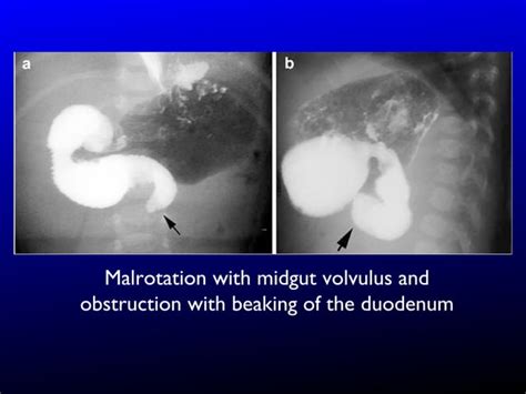 The Radiology of Malrotation