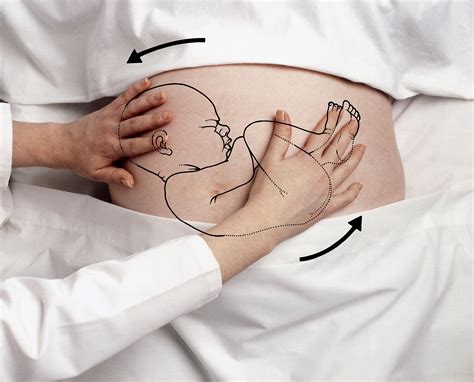 Is It Possible to Turn a Breech Baby Before Labor? | Breech babies, Turn a breech baby, Baby ...