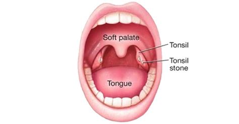 Bad Breath from Tonsil Stones | Vikram ENT Hospital