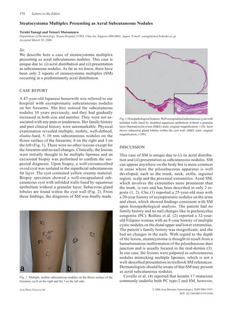 Steatocystoma Multiplex Presenting As Acral Subcutaneous Nodules - DocsLib