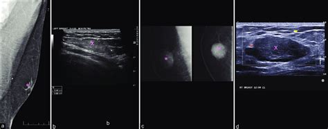 Angiolipoma: Male patient presented with palpable abnormality (a and ...