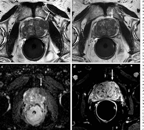 [PDF] Local staging of prostate cancer with MRI. | Semantic Scholar