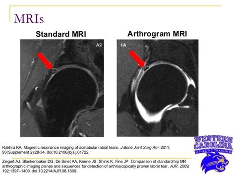 Right Hip Labral Tear in a 22 Year-Old Collegiate Male