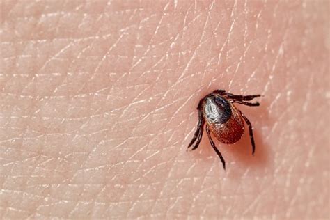 Deer Tick Embedded In Skin By Science Stock Photography ...