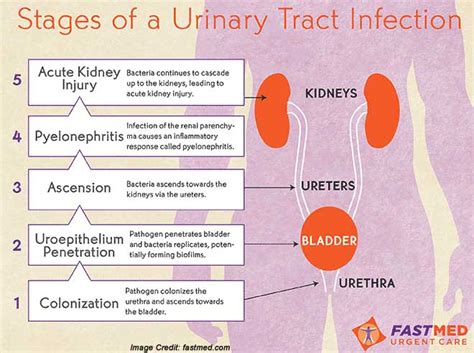 To Know More About Prostatitis - Signs, Symptoms and Treatment