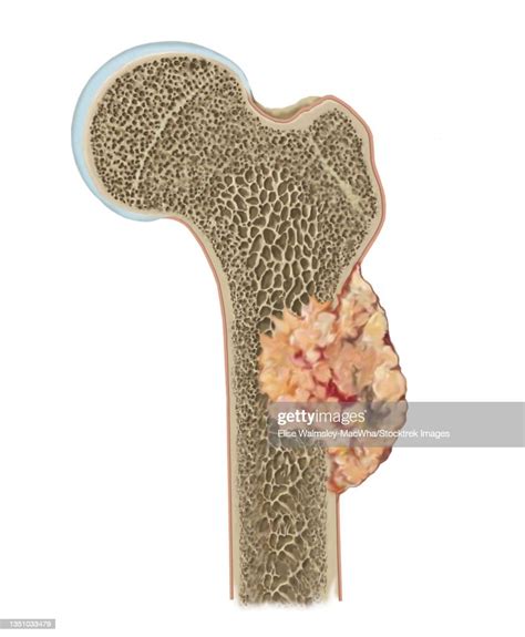 Detail Of Osteosarcoma On Femur High-Res Vector Graphic - Getty Images