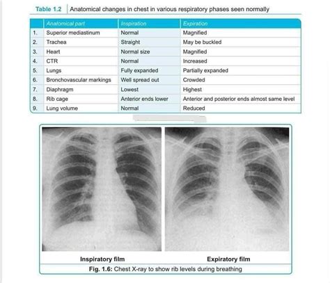 Radio diagnosis - Chest x ray nd diffrnt b/w ap nd pa view