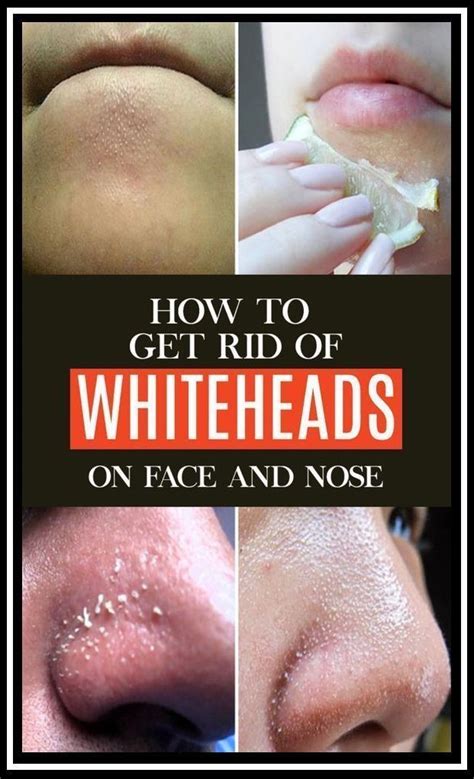 Home Remedies To Get Rid of Whiteheads in 2020 | Whiteheads, How to get rid, Skin care tips