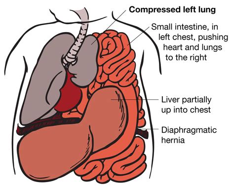 Illustration of CDH with lung compression | Medical ultrasound ...