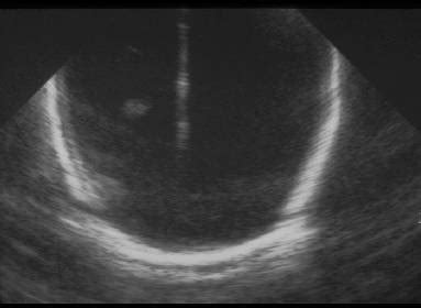 Hydranencephaly And Porencephaly