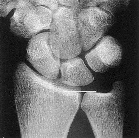 Ulnar Variance - Hand - Orthobullets