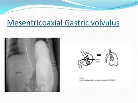 Gastric volvulus and other types of volvulus