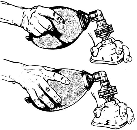 Figure 11.18, [Operation of a Bag Valve Mask]. - Nursing Skills - NCBI Bookshelf