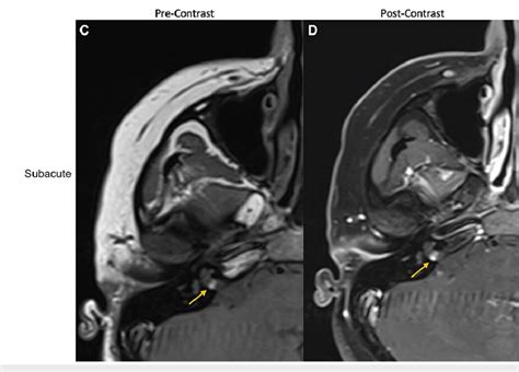 Right IAC lesion on MRI with and without contrast at subacute (two days... | Download Scientific ...