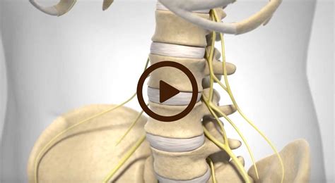 Lumbar Degenerative Disc Disease - Beach Orthopedic Specialty Institute