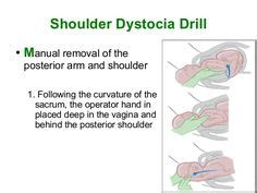 Zavanelli maneuver :cephalic replacement | Cardinal movements of labor ...