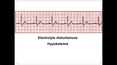 ECG Ion abnormalities Hypokalemia 2018 - YouTube