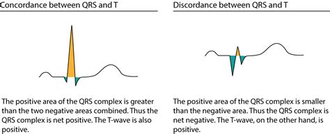 ECG interpretation: Characteristics of the normal ECG (P-wave, QRS ...