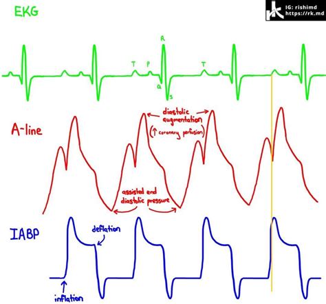 What Is An Intra-Aortic Balloon Pump (IABP)? | RK.md