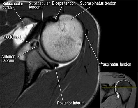 Supraspinatus Muscle Mri